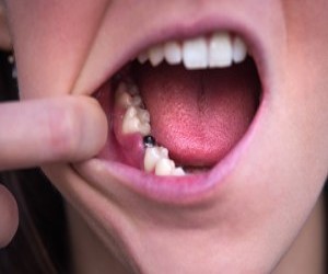 Implanturile dentare - cand se pot recomanda?